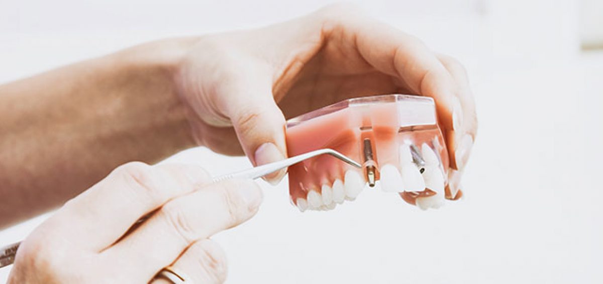 Implantes dentales en Madrid