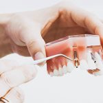 Implantes dentales en Madrid