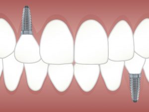 implantes dentales