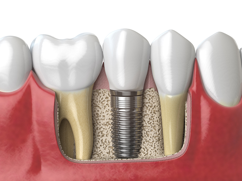 Implantes dentales 1