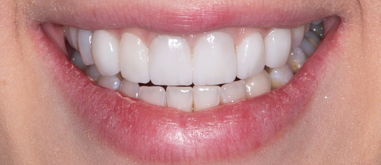 Carillas dentales 3