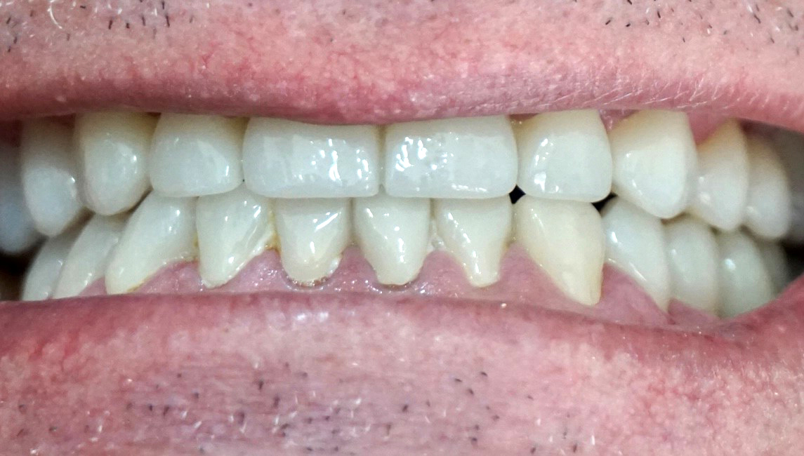 Rehabilitación completa sobre dientes con coronas de zirconio 2