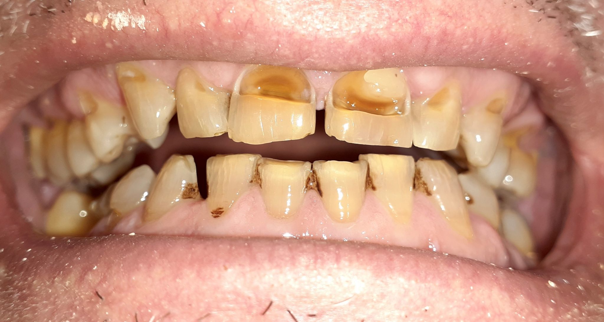 Rehabilitación completa sobre dientes con coronas de zirconio 1